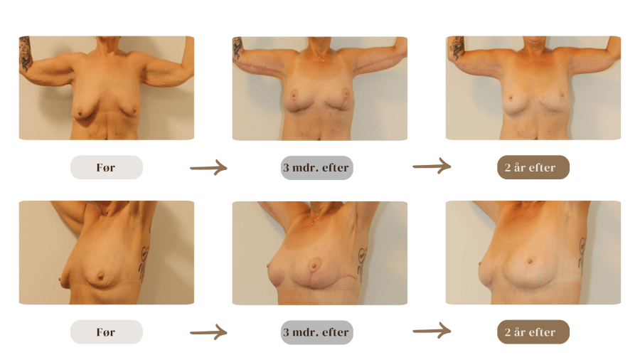 Patient med stort vægttab efter udvidet brystløft og armplastik