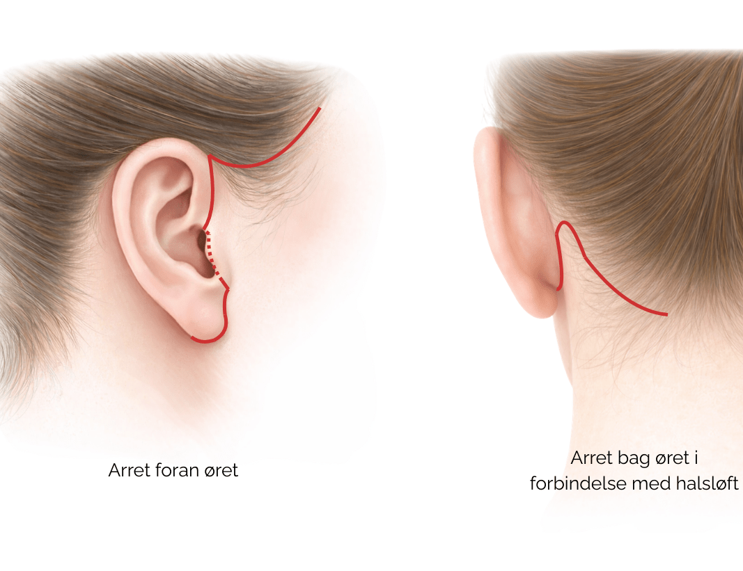 Placering af facelift-arret