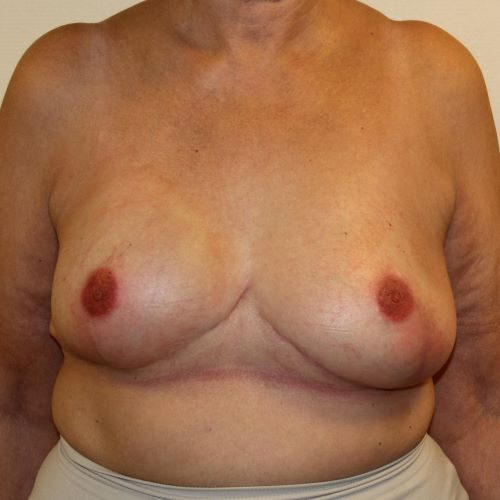 Efter billede