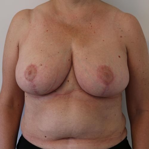 Efter billede